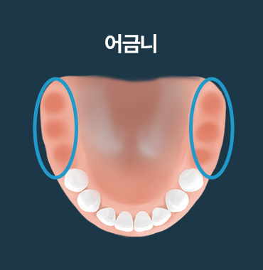 어금니