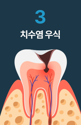 치수염 우식