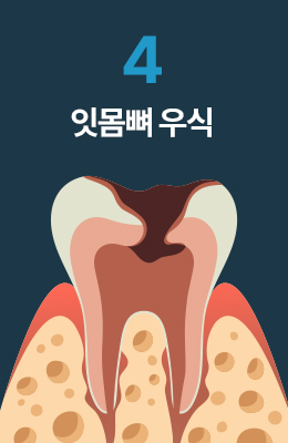 잇몸뼈 우식