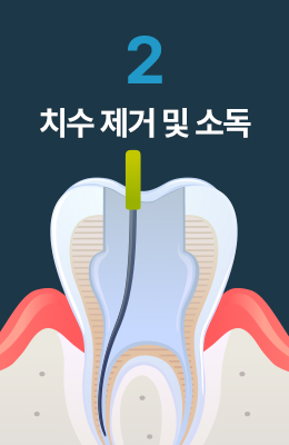 치수 제거 및 소독