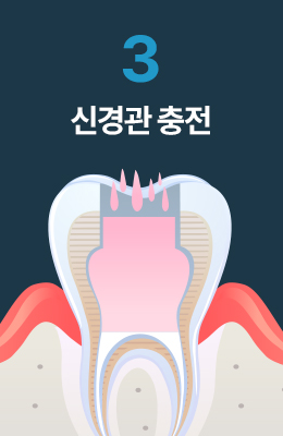 신경관 충전